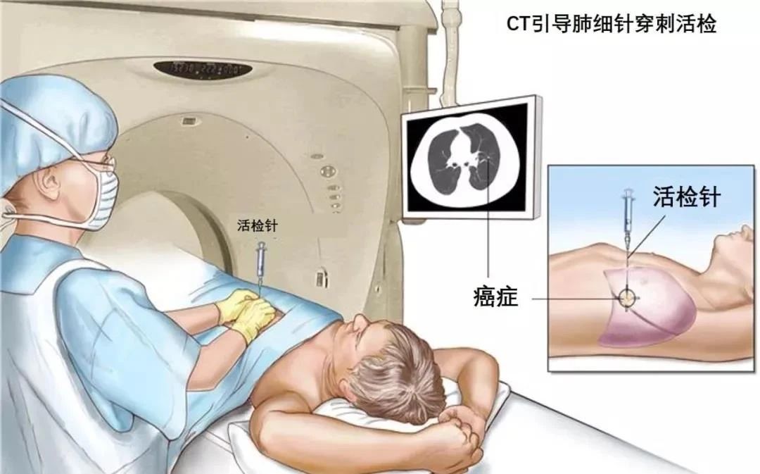 肺穿刺護(hù)理小貼士